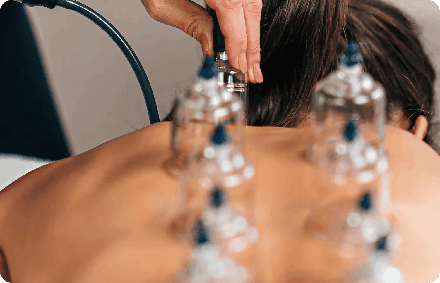 Dry cupping